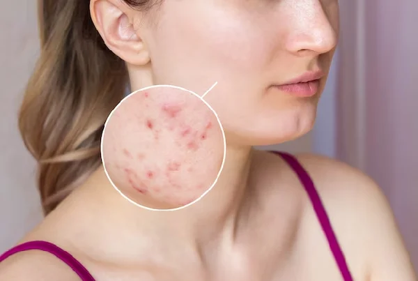 Scar Revision